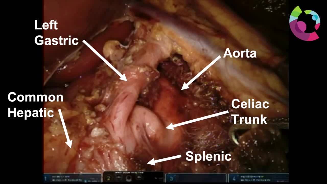 Robotic-Assisted Release of the Median Arcuate Ligament for Pediatric MALS