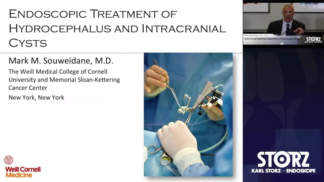 Endoscopic Treatment of Hydrocephalus and Intracranial Cysts: Pediatric...