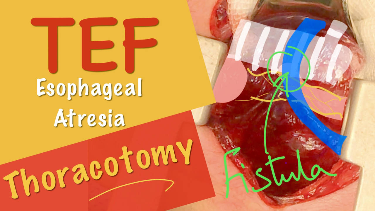 Neonatal Open Repair of Esophageal Atresia & Tracheo-esophageal Fistula EA_TEF. Dr Tamer Ashraf