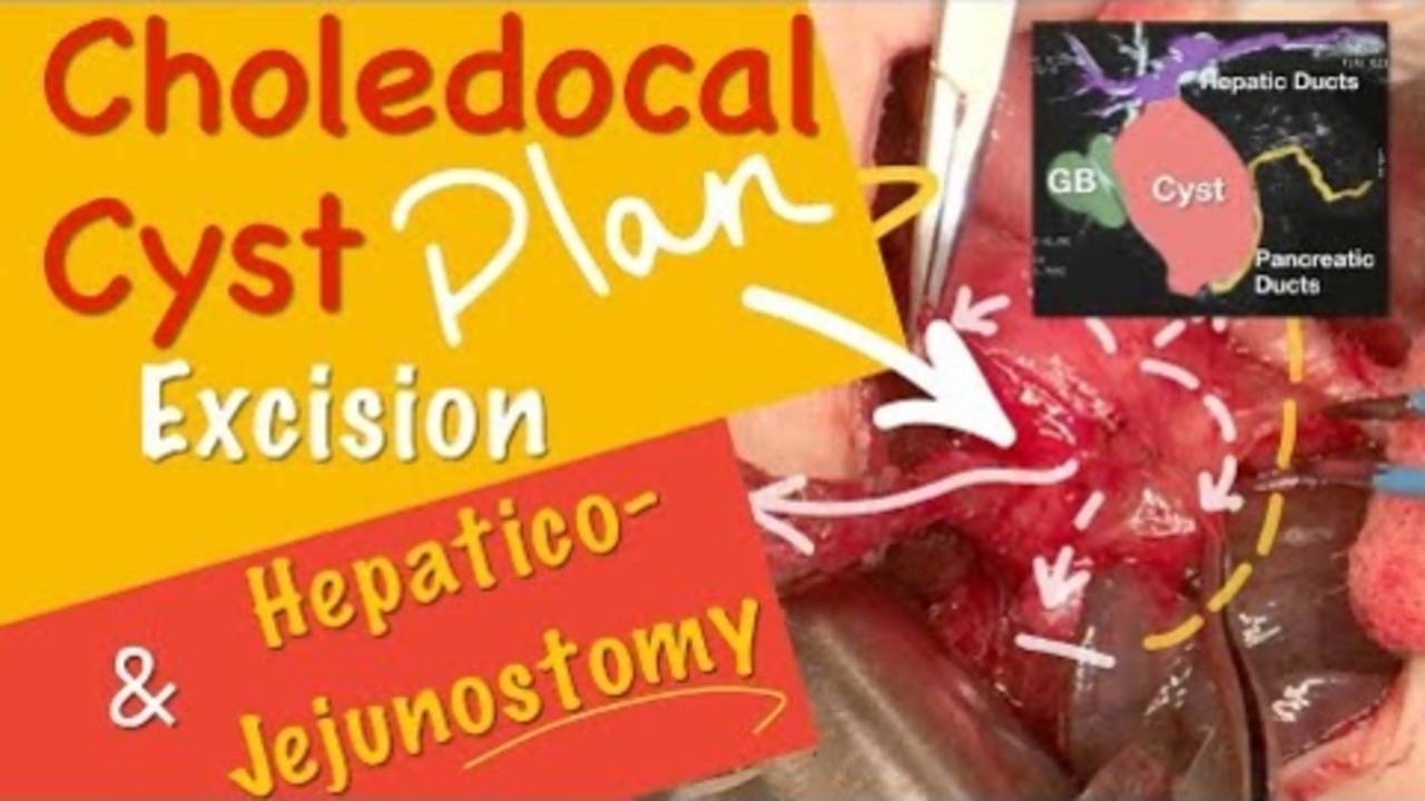 Choledocal Cyst Excision  RouxenY Hepaticojejunostomy