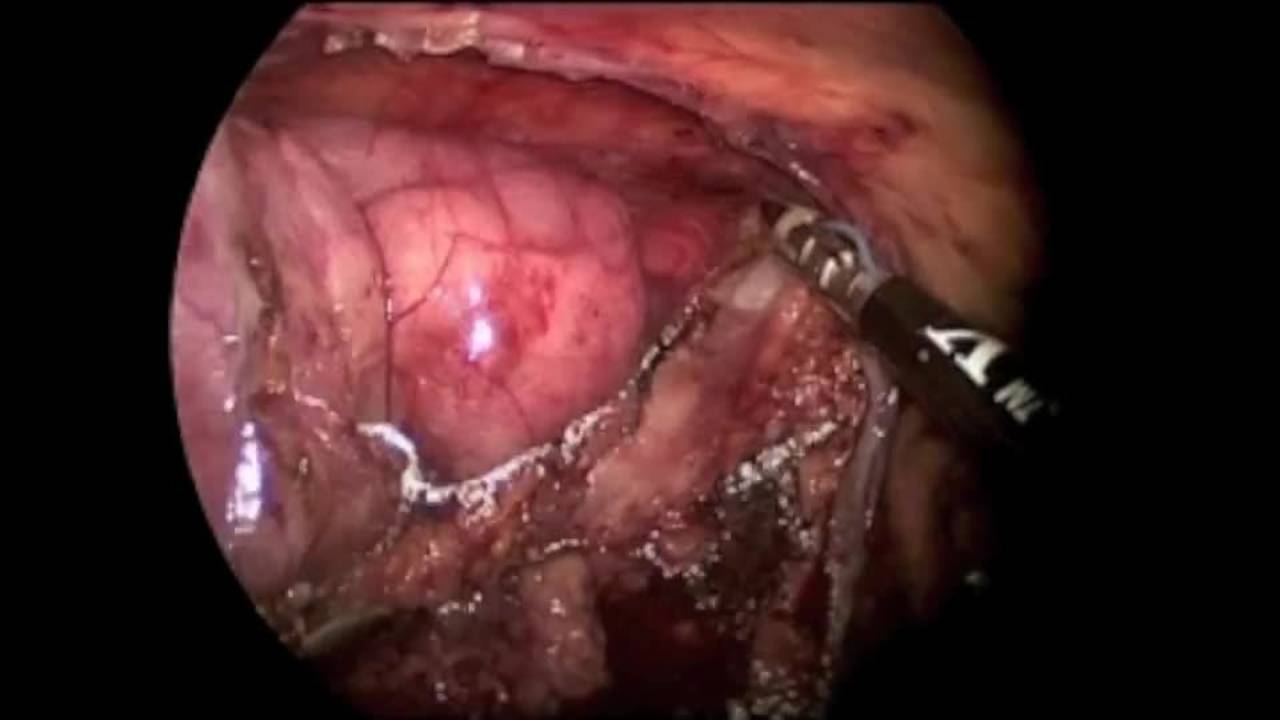 Thoracoscopic Thymectomy
