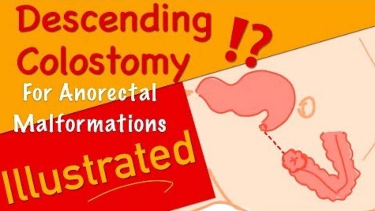 Descending Colostomy for Anorectal Malformations Dr. Tamer Ashraf Wafa