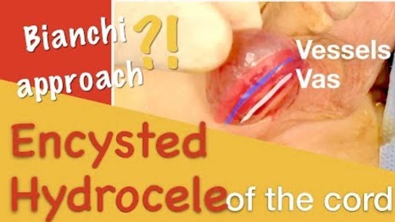 Pediatric Encysted hydrocele of the cord Bianchi incision By Dr. Tamer Ashraf...