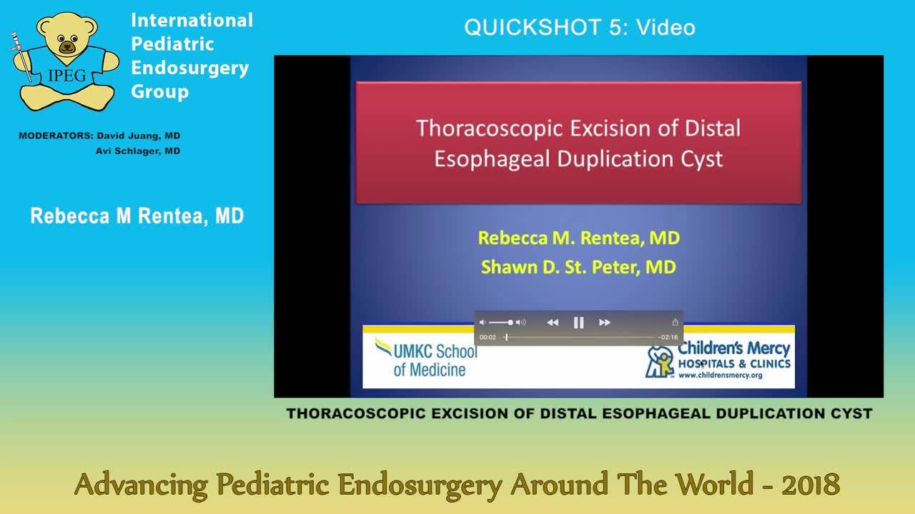 IPEG 2018 - THORACOSCOPIC EXCISION OF DISTAL ESOPHAGEAL DUPLICATION CYST