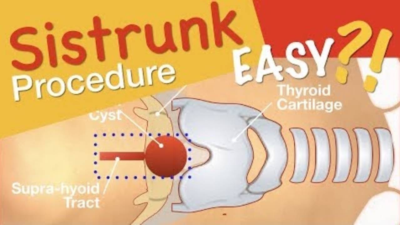 Sistrunk Procedure Thyroglossal Cyst Excision Dr. Tamer Ashraf Wafa