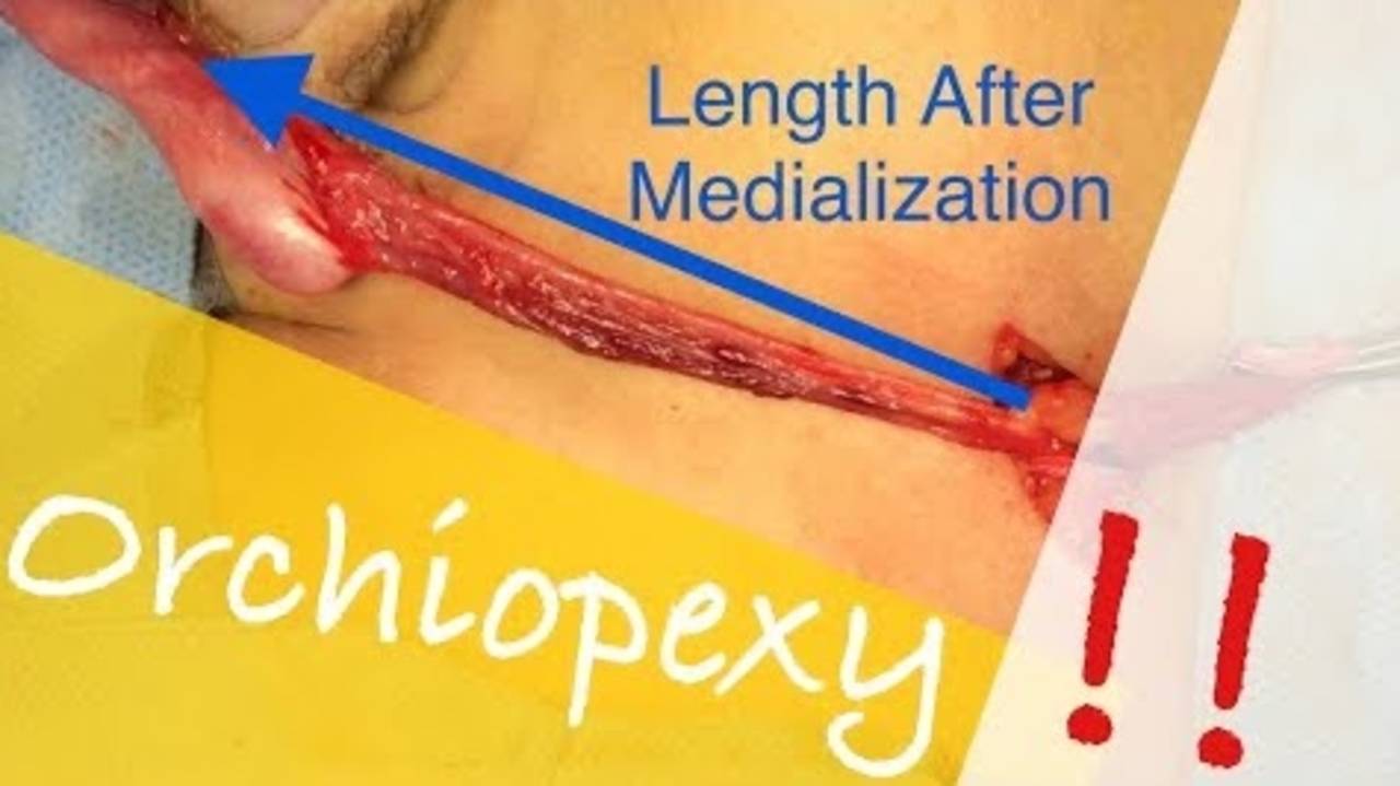 Orchiopexy for Left Undescended Testis (One year old boy) By Dr. Tamer Ashraf Wafa