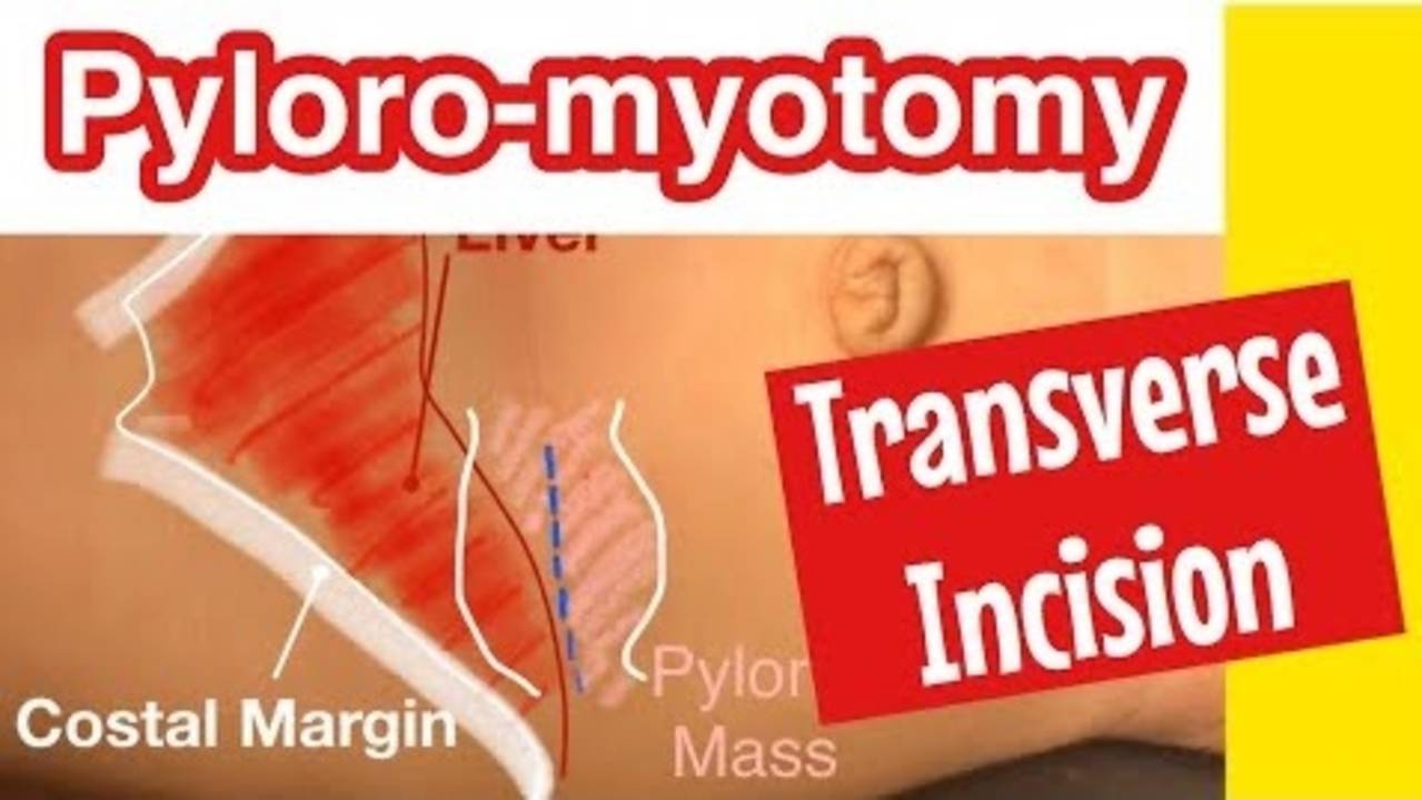 Open Pyloromyotomy Transverse Incision. (Infantile Hypertrophic Pyloric...