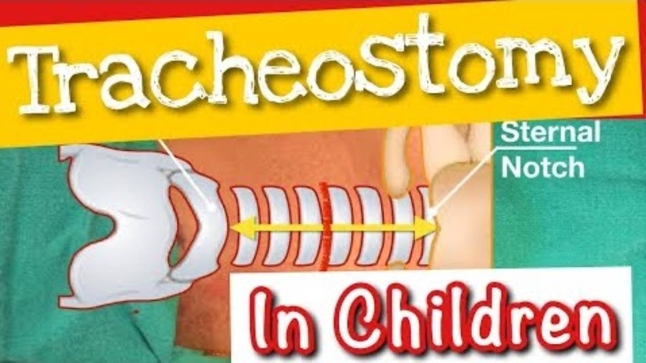 Pediatric Tracheostomy in a 7 year old child Dr. Tamer Ashraf Wafa
