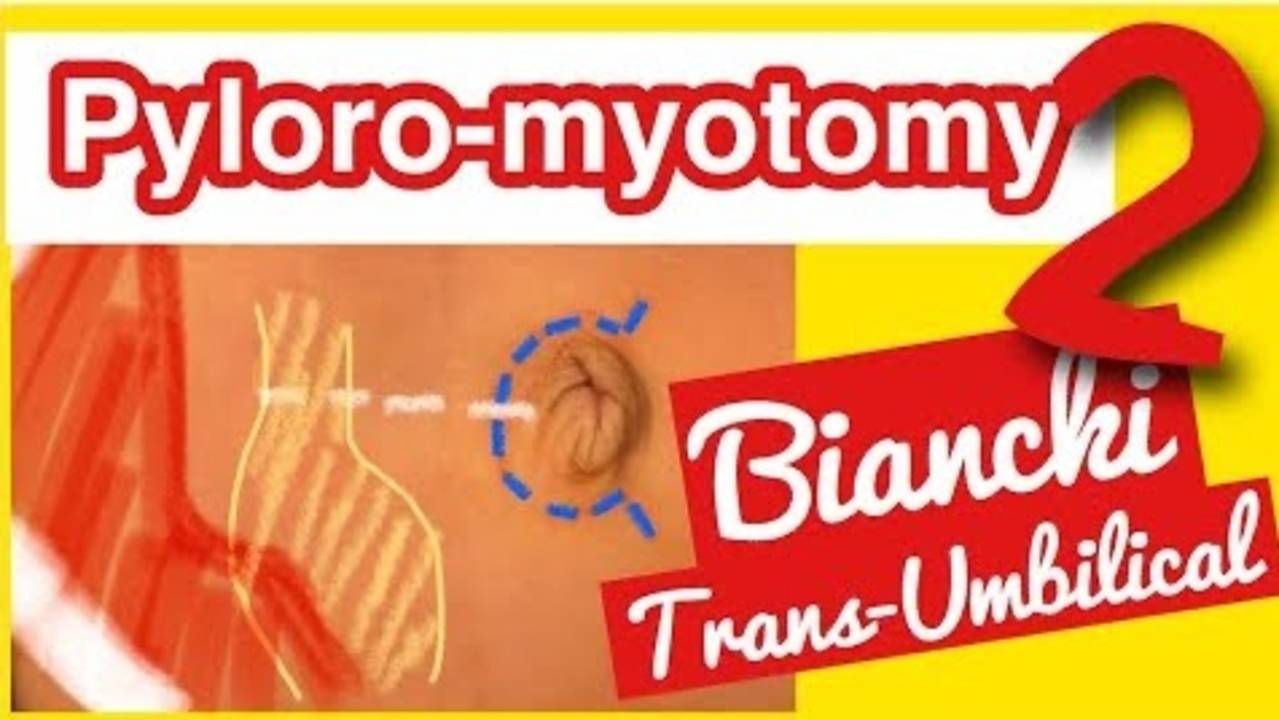 Open Pyloromyotomy Bianchi Supraumbilical approach Dr. Tamer Ashraf Wafa and...