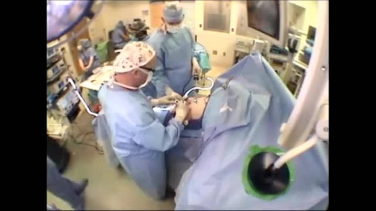 Bariatric Partial Gastrectomy Technique: Adolescent Obesity 2013