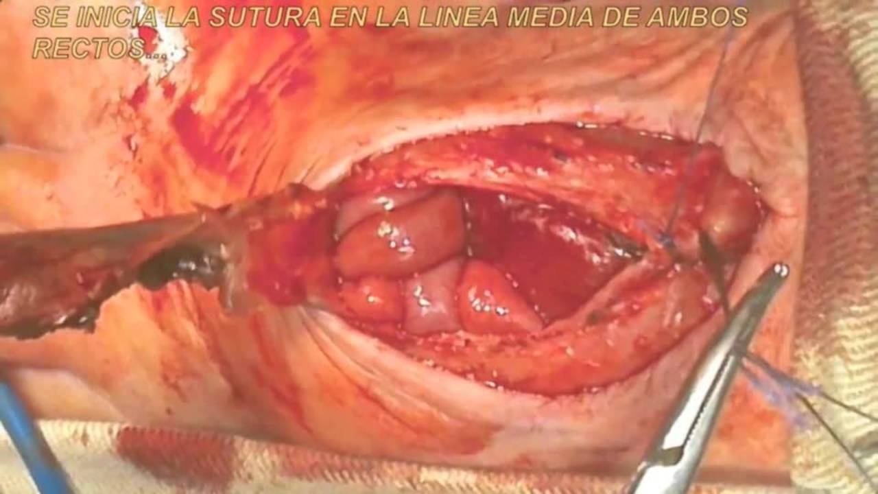 Approach and component separation for suture closure and underlay mesh...