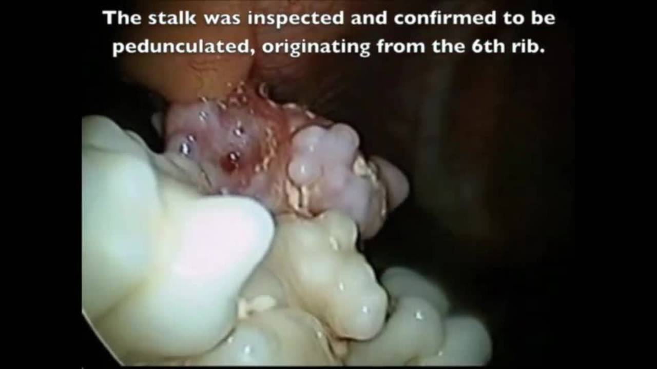 Thoracoscopic-Assisted Partial Rib Resection: Pediatric Surgery Difficult...