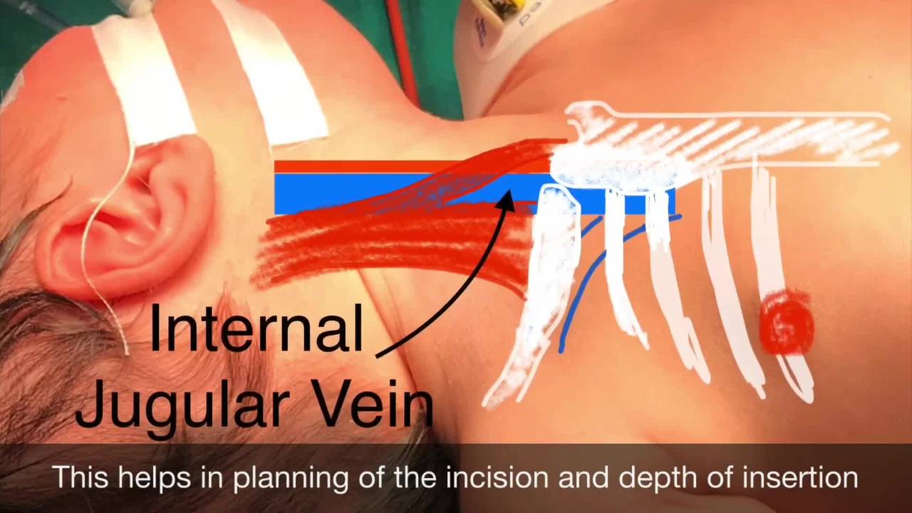 Open CVP Catheter Insertion Internal jugular vein Cutdown By Dr. Tamer Ashraf...