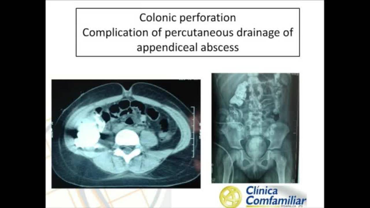 Colonic Perforation-Complication of Percutaneous Drainage of Appendiceal...