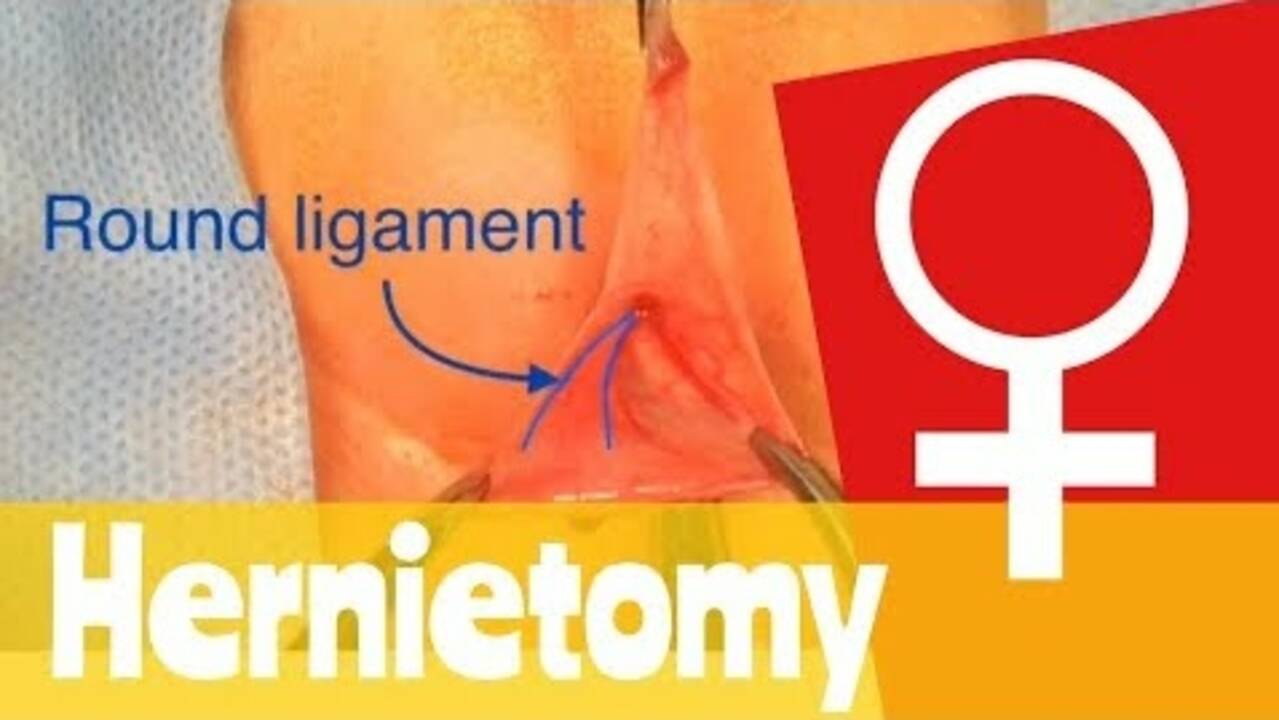 Female Neonatal Inguinal Hernia Repair Dr. Tamer Ashraf Wafa