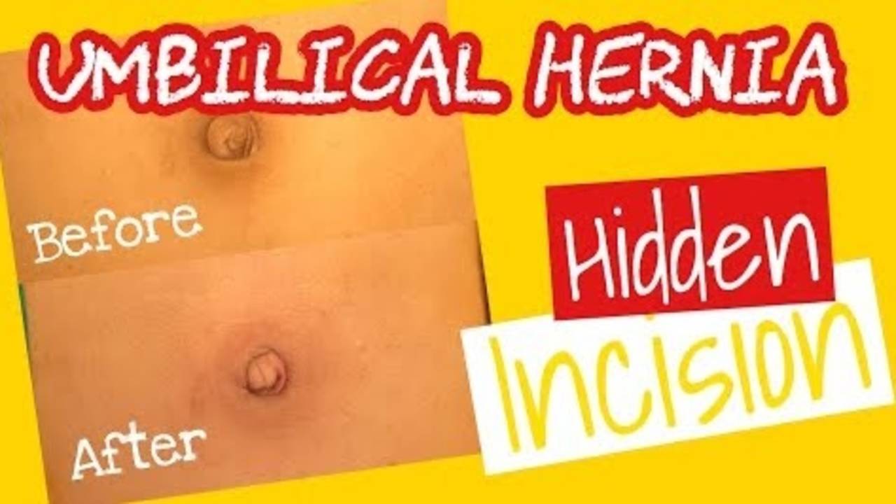 Umbilical Hernia Repair in Children Anatomical Repair Hidden incision Dr....