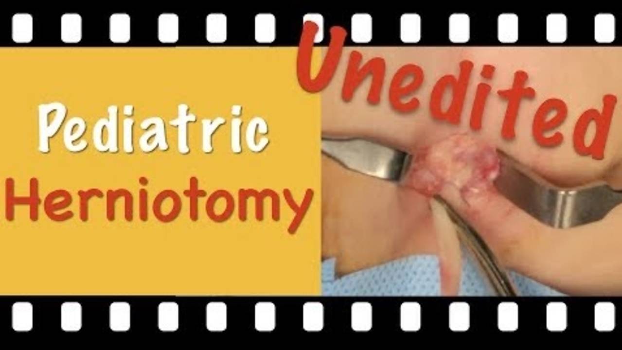 Pediatric Open Herniotomy in boys 15 Minutes Unedited Dr. Tamer Ashraf Wafa