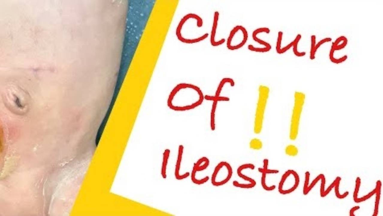 Ileostomy closure Takedown in a 1 month old girl  By Dr. Tamer Ashraf Wafa...