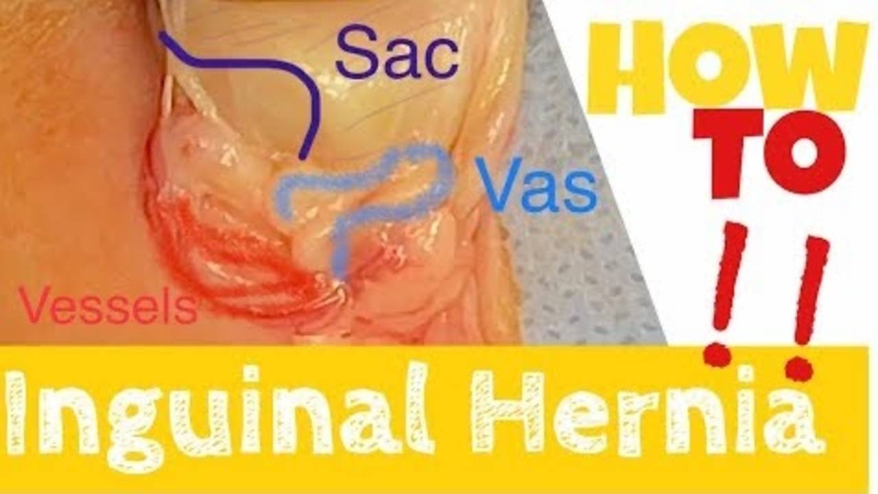 Herniotomy in a Neonate 1 month old boy By Dr. Tamer Ashraf Wafa