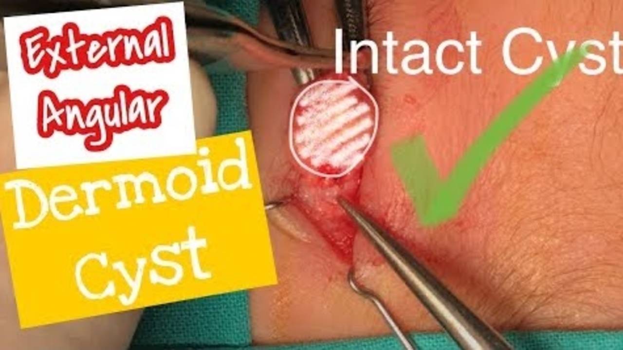 Dermoid Cyst External Angular Dermoid Excision How to and Tricks for a Hidden...