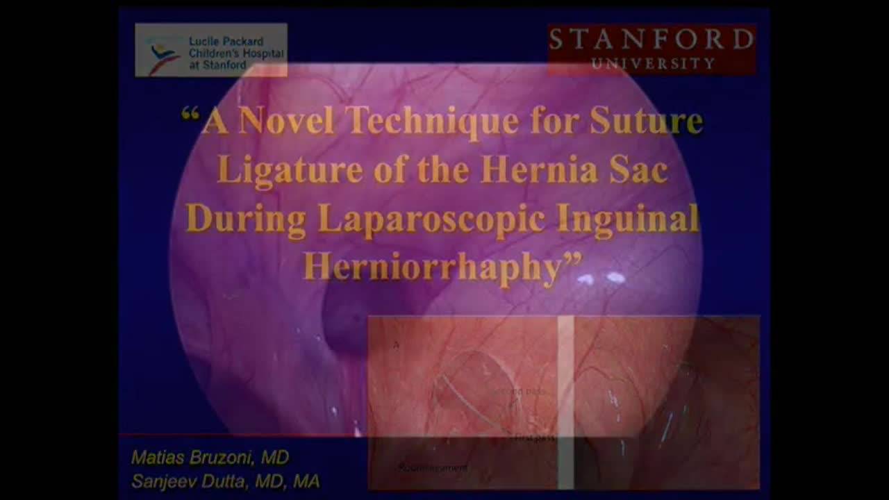 How I Do It: Dutta Lap Hernia