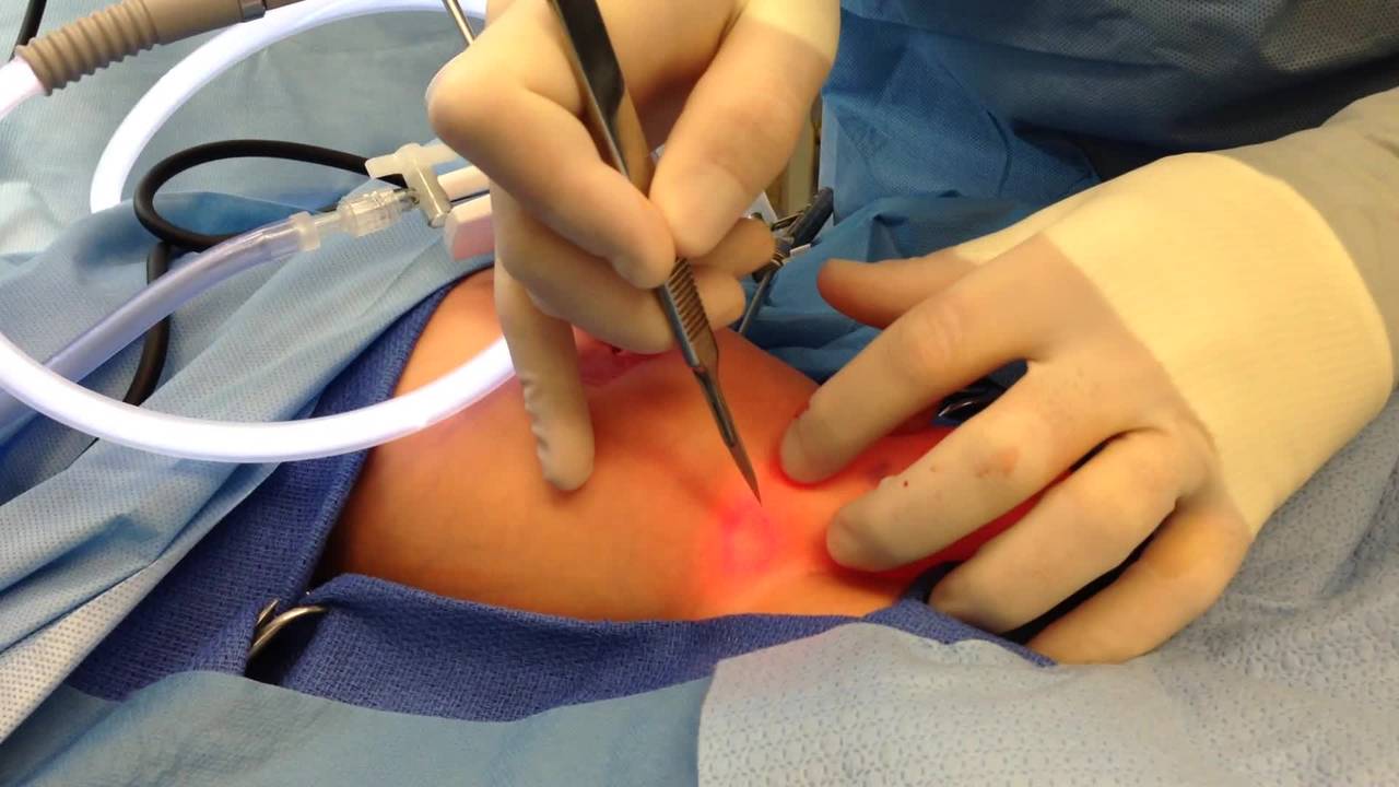Laparoscopic Inguinal Hernia Repair