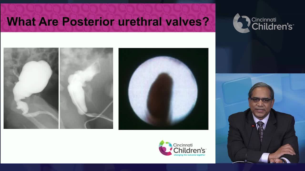 What Are Posterior Urethral Valves