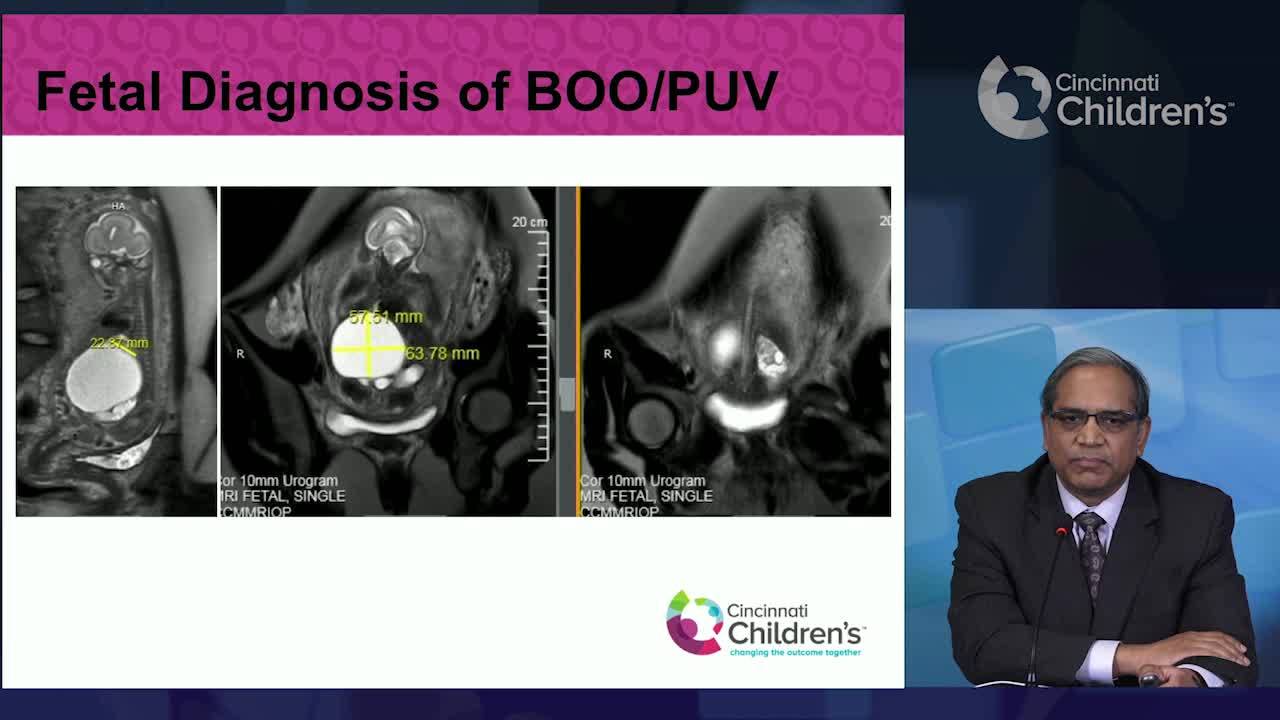 What Is A Bladder Outlet Obstruction