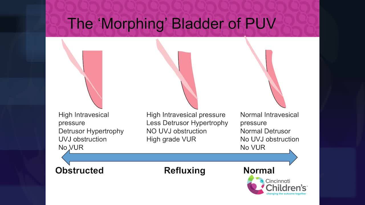 The Morphing Bladder of PUV
