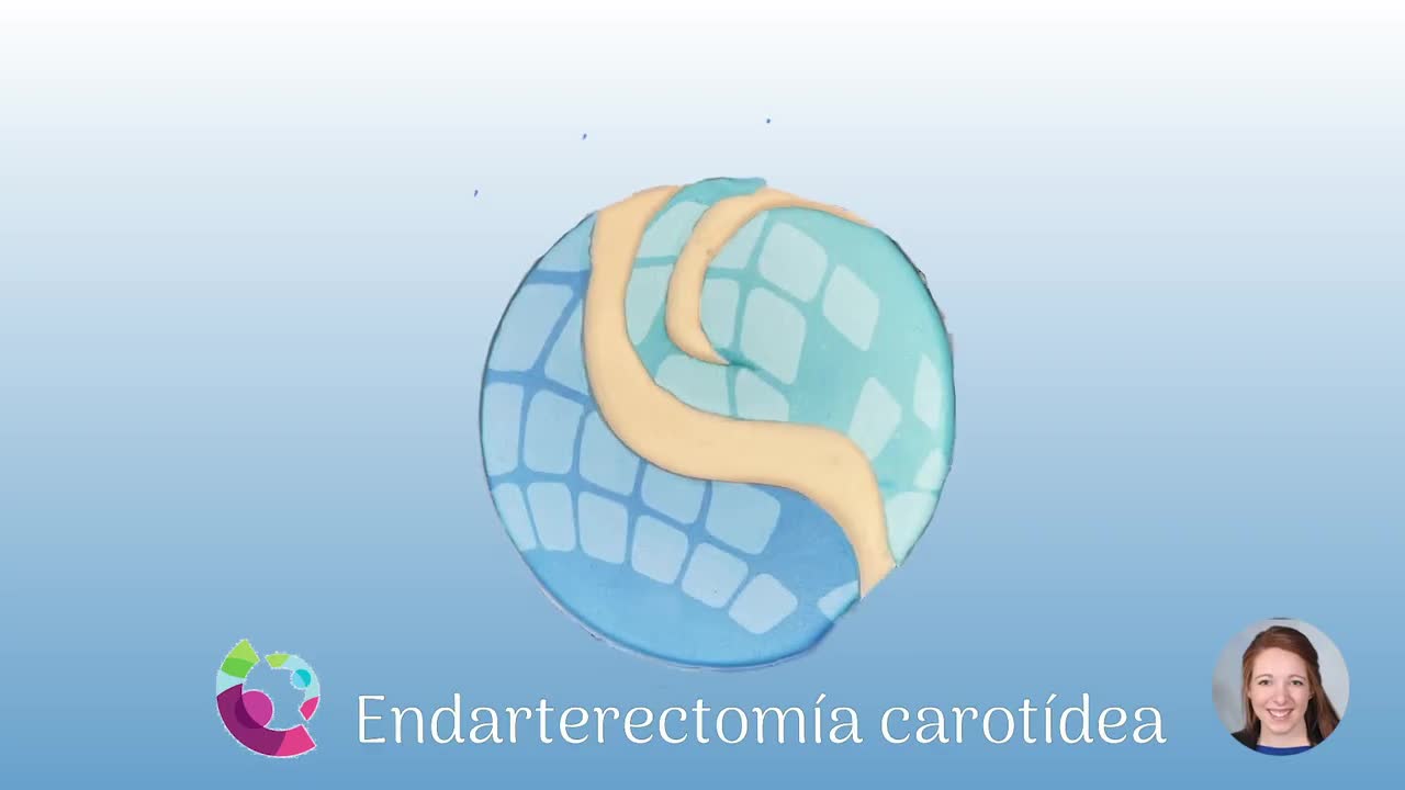 Endarterectomía Carotidea