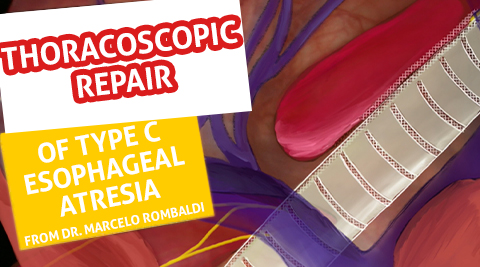 Thoracoscopic repair of type C esophageal atresia