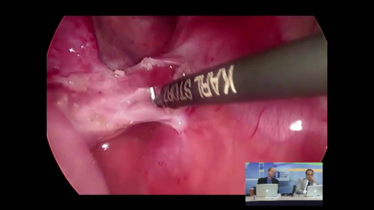 Technique - Left Lower Lobectomy for Sequestration