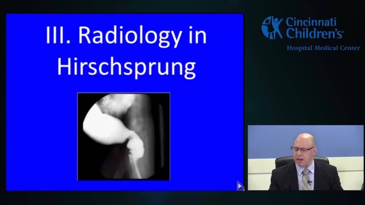 Evaluation & Management Of Hirschsprung's Disease