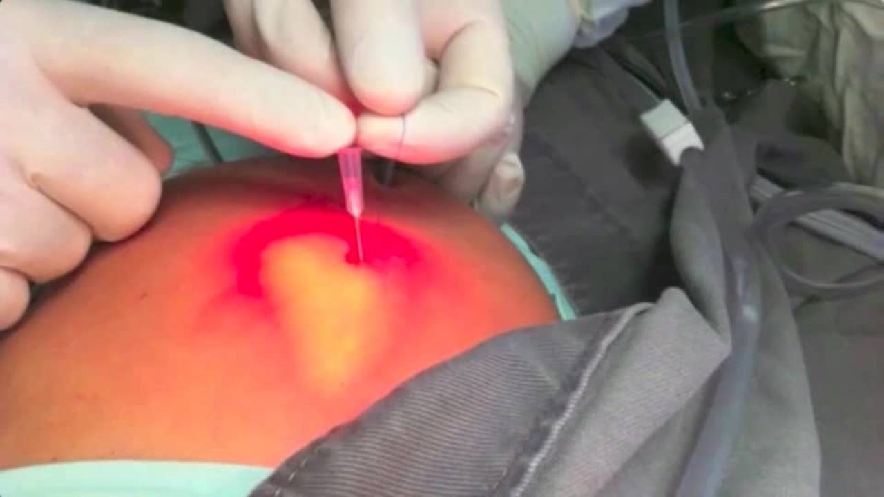 Tricks - Laparoscopic Epigastric Herniorrhaphy