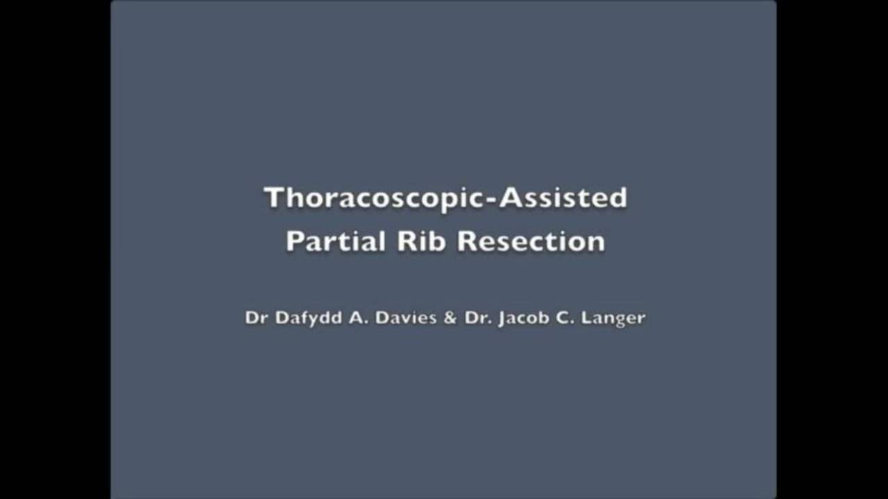Tricks - Thoracoscopic-Assisted Partial Rib Resection - Jack Langer