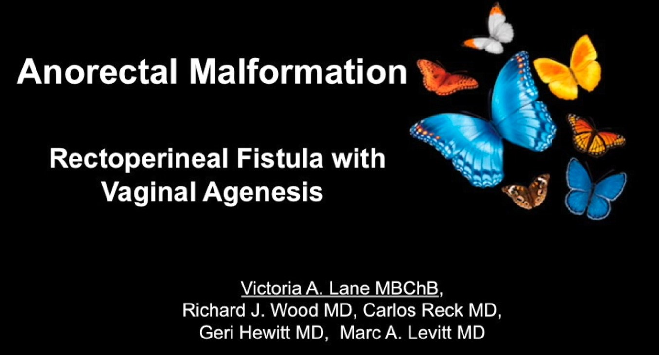 Rectoperineal Fistula with Vaginal Agenesis