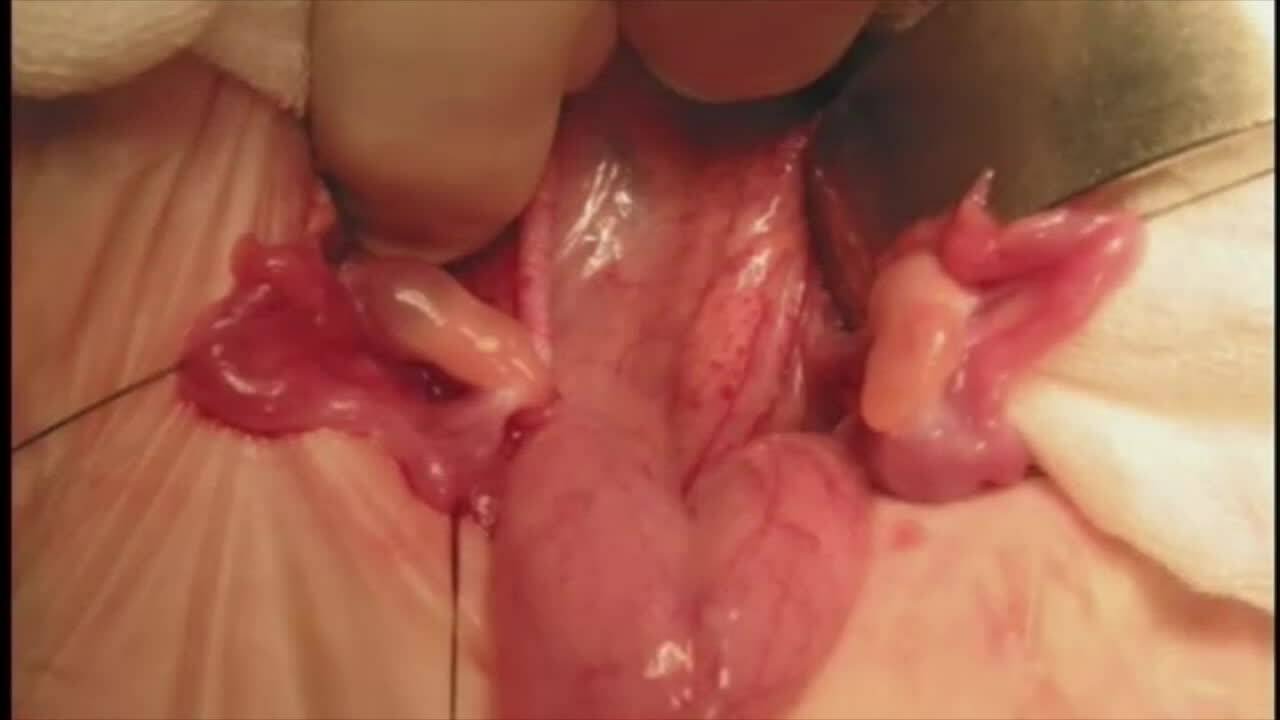 Imperforated Anus with Rectovestibular fistula and absent or atretic Vagina (No audio)