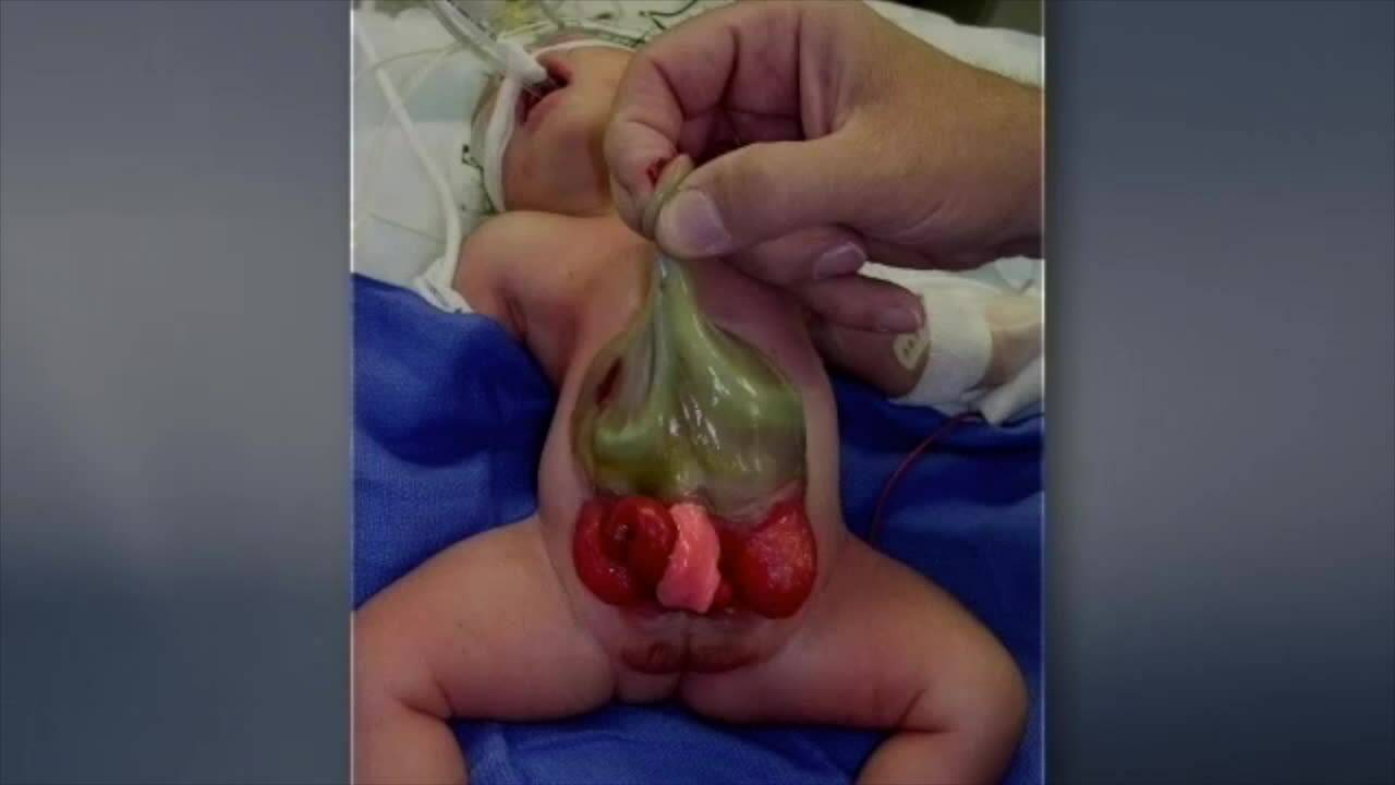 CCPR Cloacal exstrophy