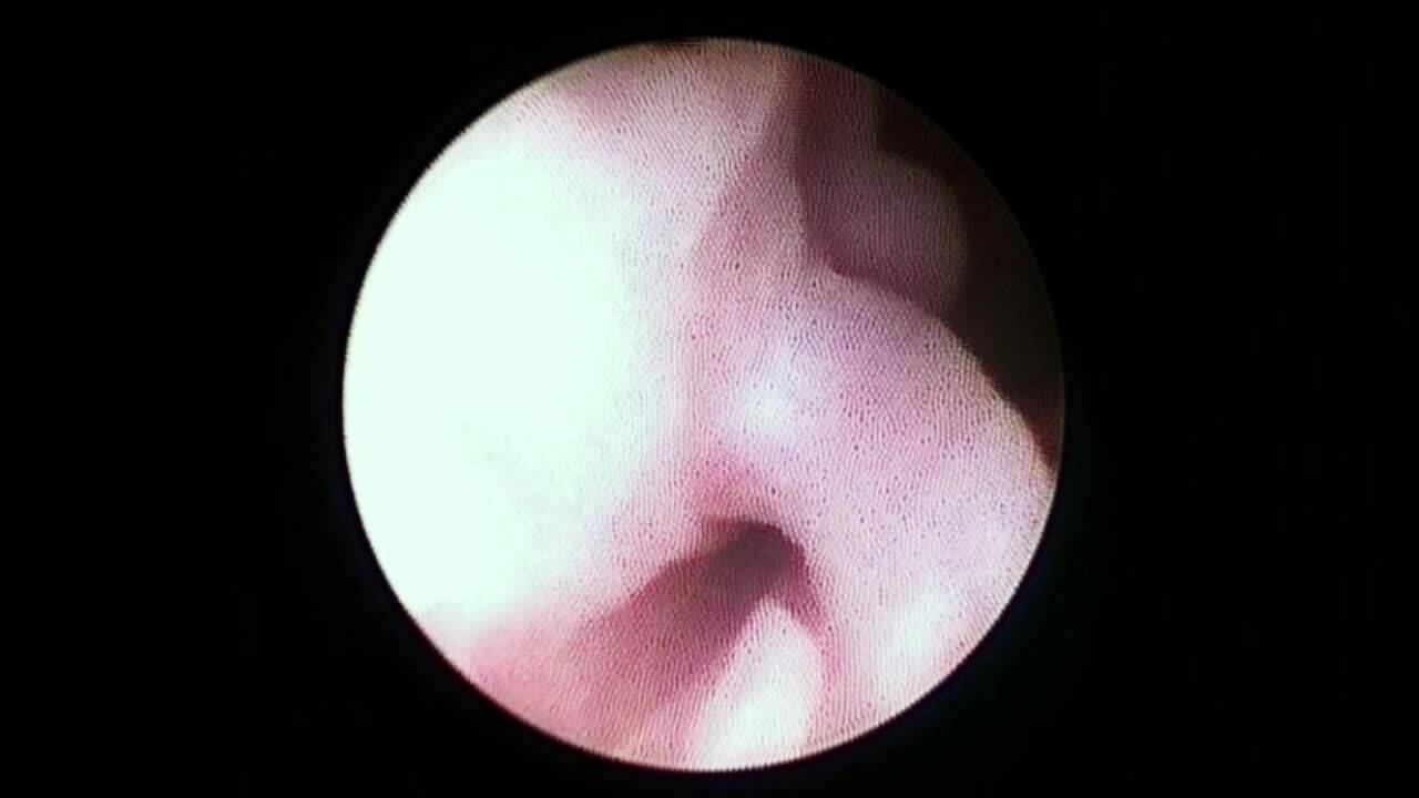 Cystoscopy cloaca 2cm Common Channel