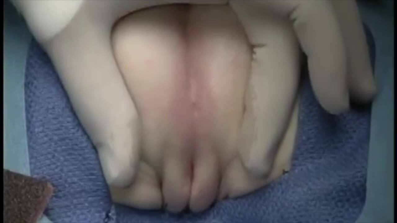 CCPR Surgical treatment of complex cloaca malformation