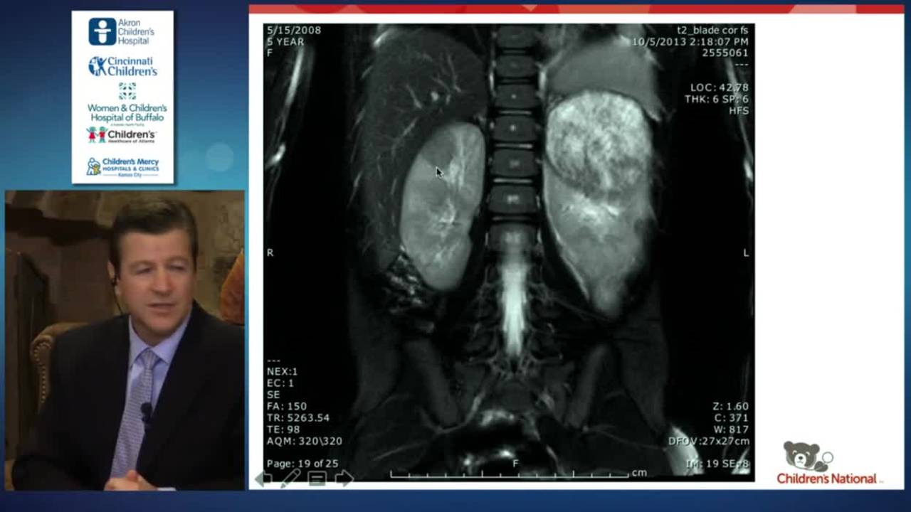 Bilateral Wilm's Tumor - Complex Gastroschisis - Complex Ileal Atresia:...