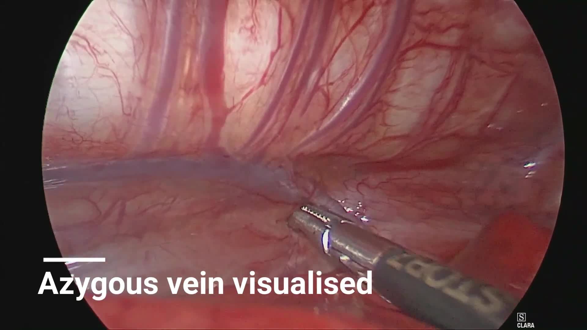 IPEG 2020 Top Abstract: Thoracoscopic Repair of an extremely rare variant of Esophageal atresia with Tracheoesophageal fistula