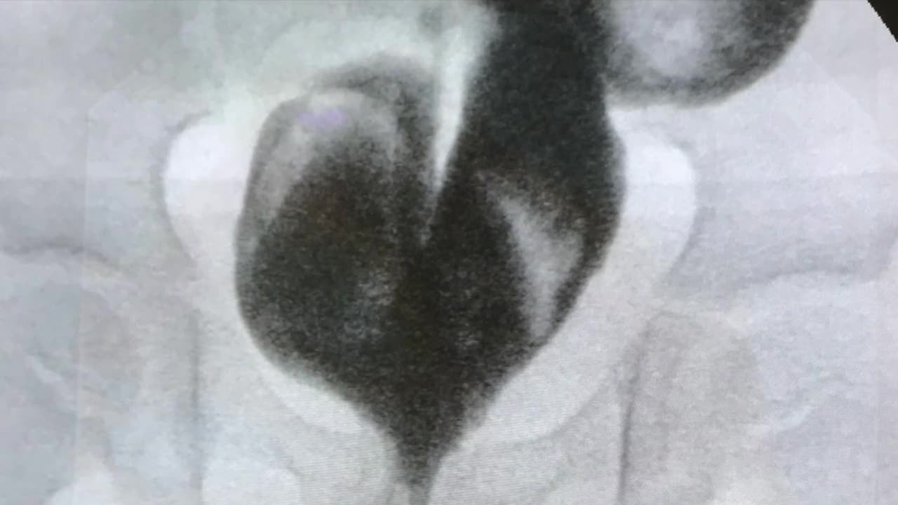 IPEG 2020 TOP ABSTRACT: Robotic excision of redundant rectal pouch in HSCR after Duhamel procedure