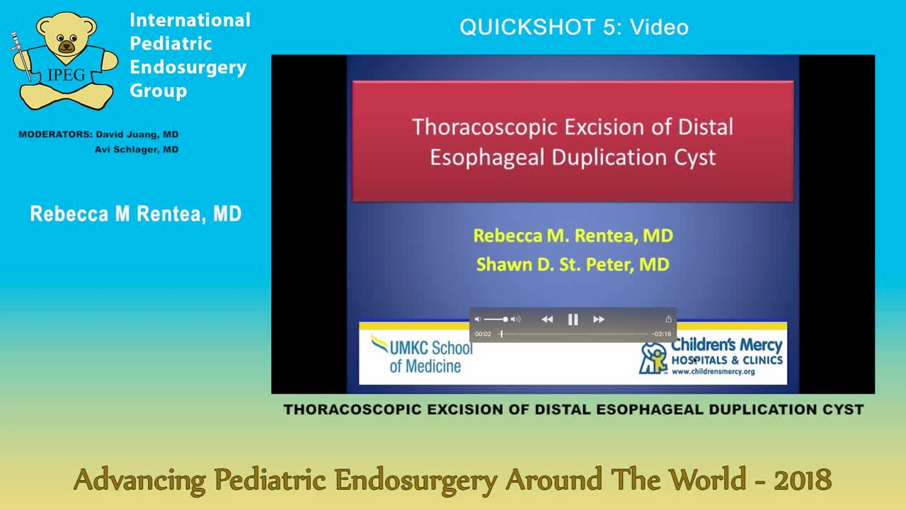 THORACOSCOPIC EXCISION OF DISTAL ESOPHAGEAL DUPLICATION CYST