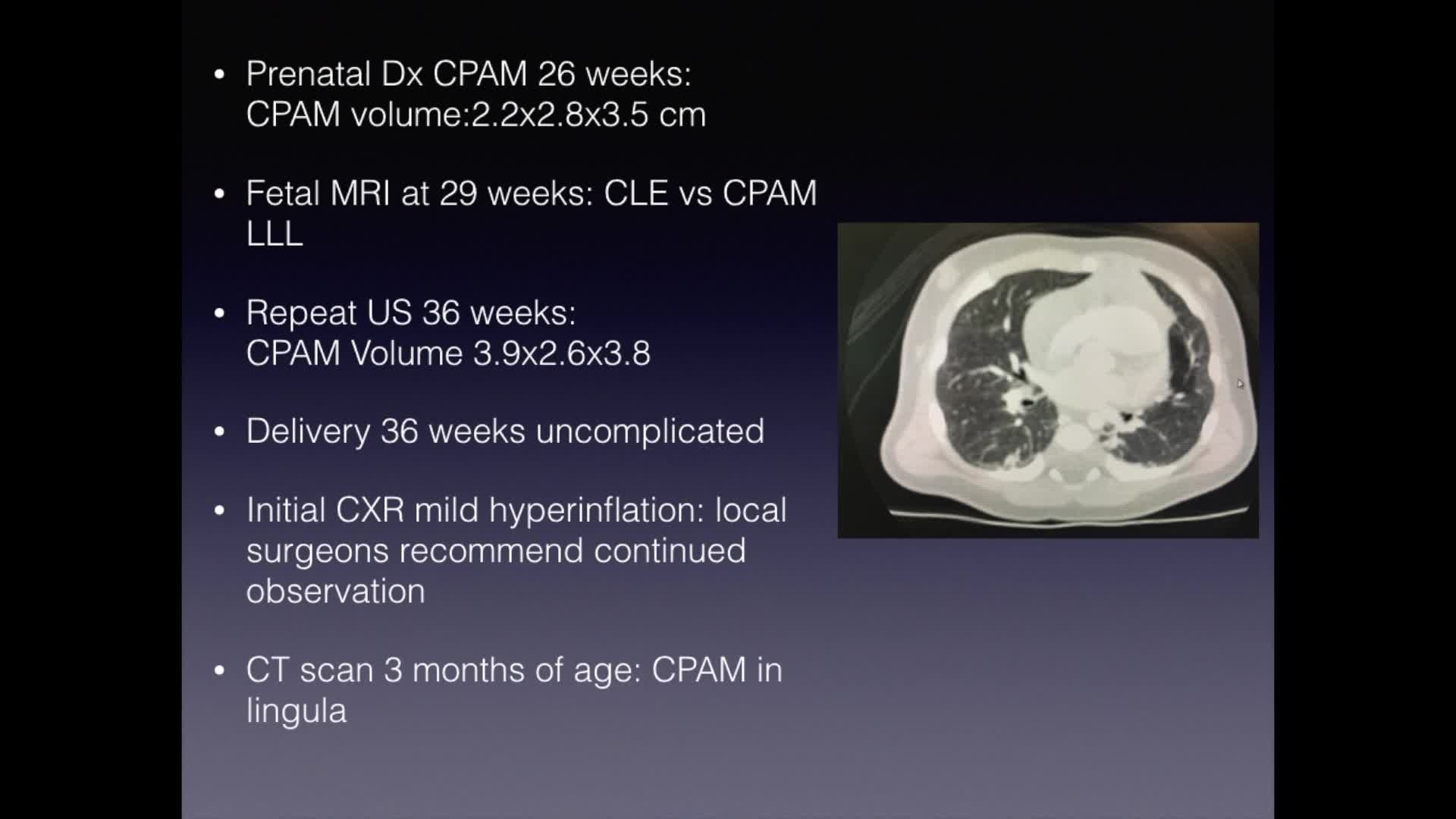 IPEG 2020 TOP ABSTRACT: Thoracoscopic lingulectomy for a Prenatally diagnosed CPAM in a 3 month old infant