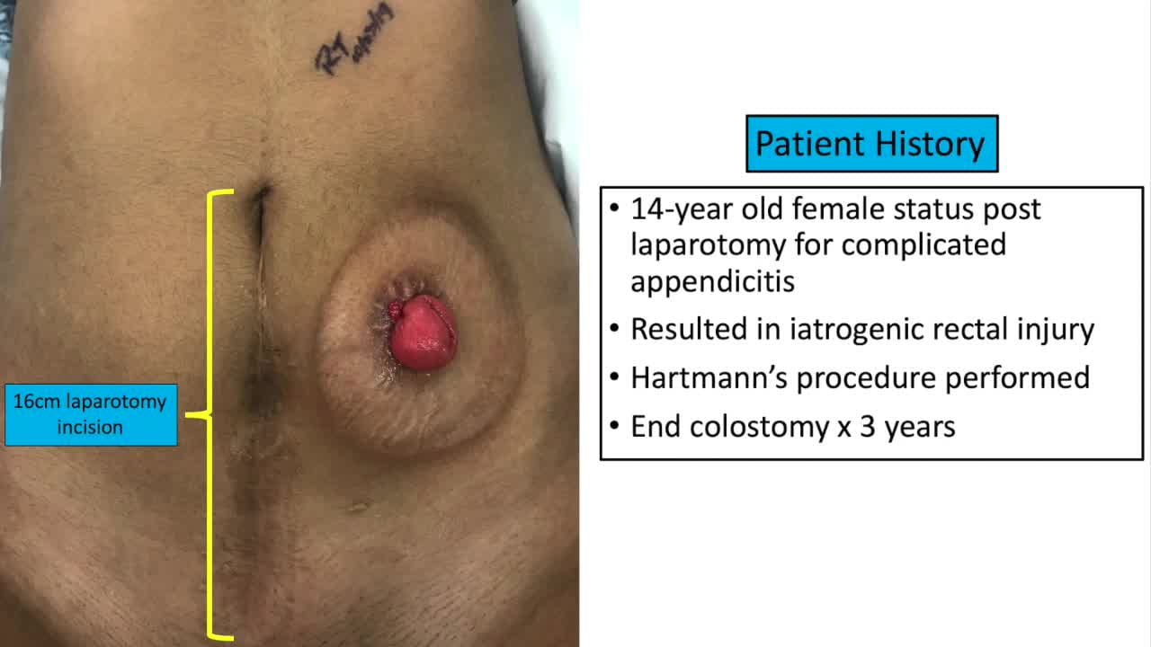 IPEG 2020 TOP ABSTRACT: Robotic Colostomy Takedown in a Pediatric Patient