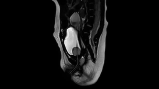 IPEG 2020 TOP ABSTRACT: Cloaca repair with image-guided and combined endoscopic and laparoscopic (CELS) anorectoplasty with d...