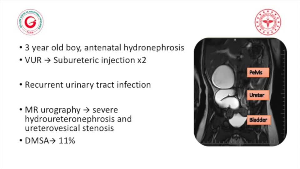 IPEG 2020 TOP ABSTRACT: Robotic Surgery for Iatrogenic Ureterovesical Stenosis