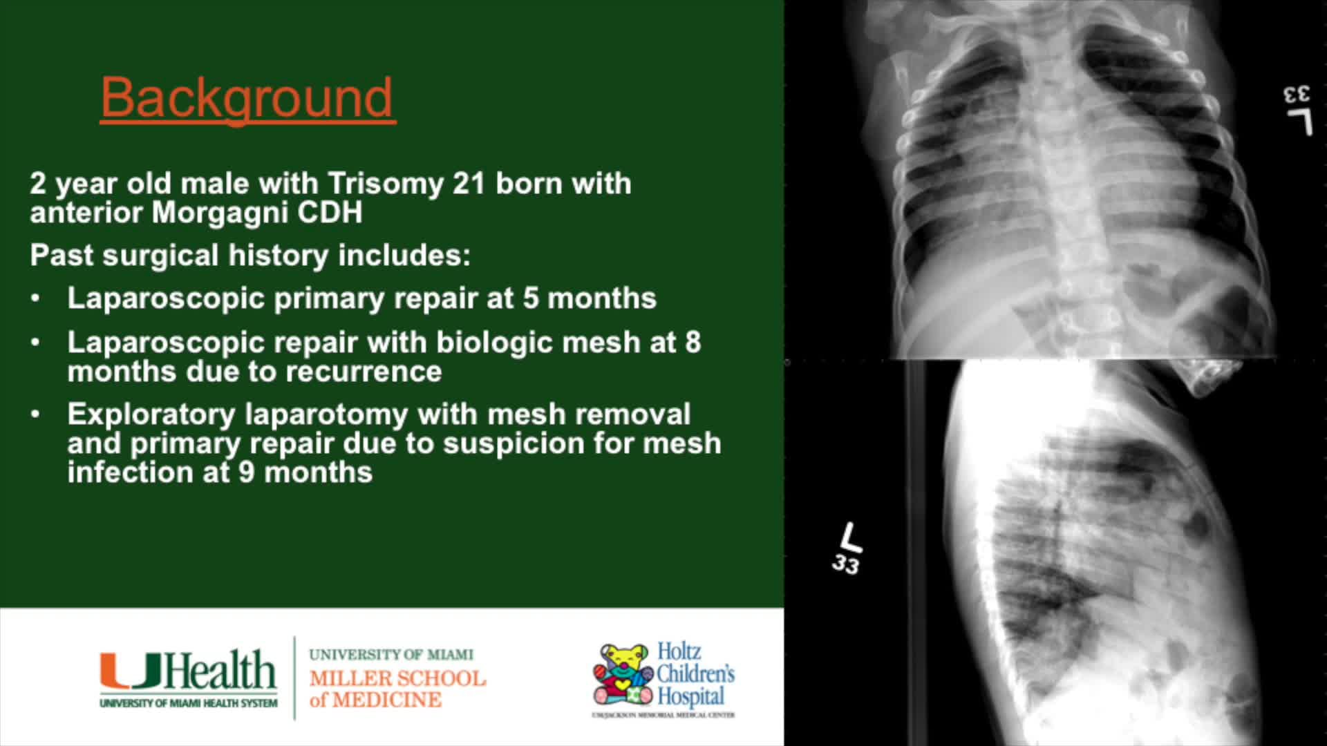 IPEG 2020 TOP ABSTRACT: Laparoscopic Repair of a Complicated Morgagni Hernia after Multiple Recurrences