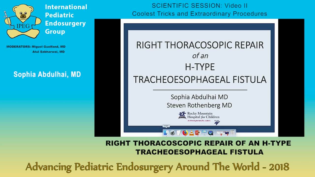RIGHT THORACOSCOPIC REPAIR OF AN H-TYPE TRACHEOESOPHAGEAL FISTULA